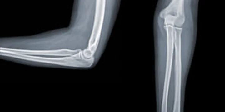 Reducción y fijación de fracturas